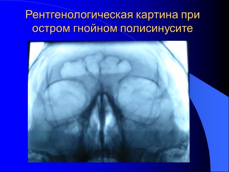 Рентгенологическая картина при остром гнойном полисинусите